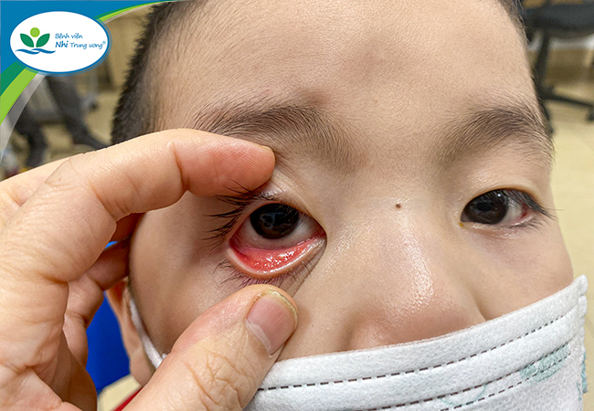 Be careful with symptoms of conjunctivitis in children after Covid-19 - Photo 2.