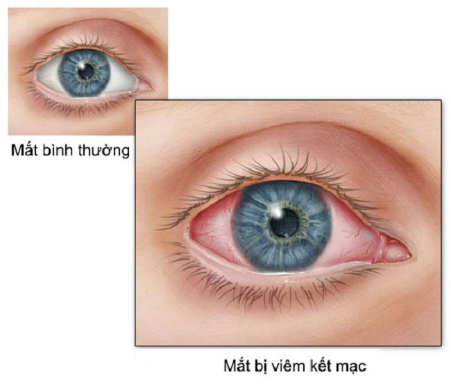 Be careful with symptoms of conjunctivitis in children after Covid-19 - Photo 1.