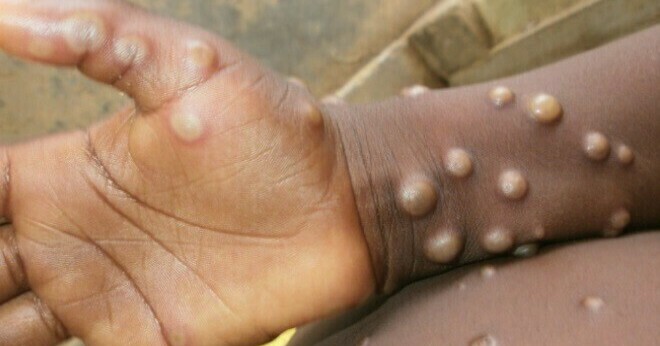12 countries have recorded monkeypox, Vietnam closely monitors, closely monitors