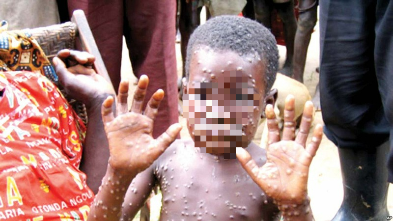 The Ministry of Health recommends 6 measures to prevent monkeypox disease - Photo 1.