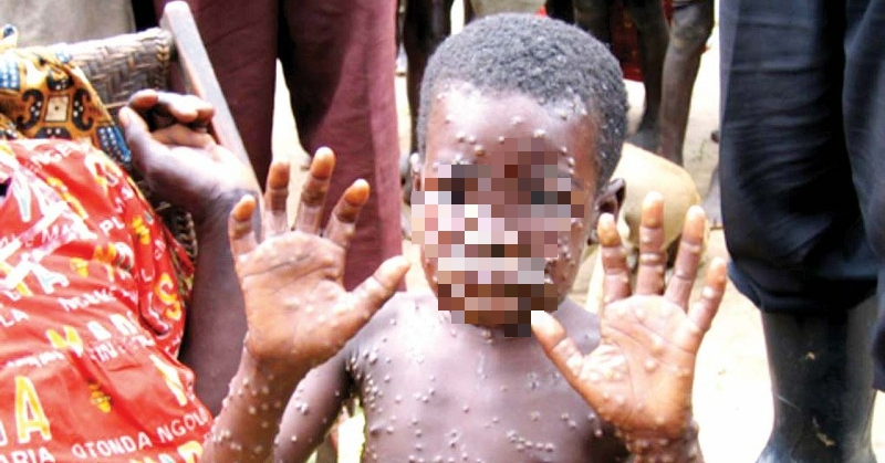 The Ministry of Health recommends 6 measures to prevent monkeypox