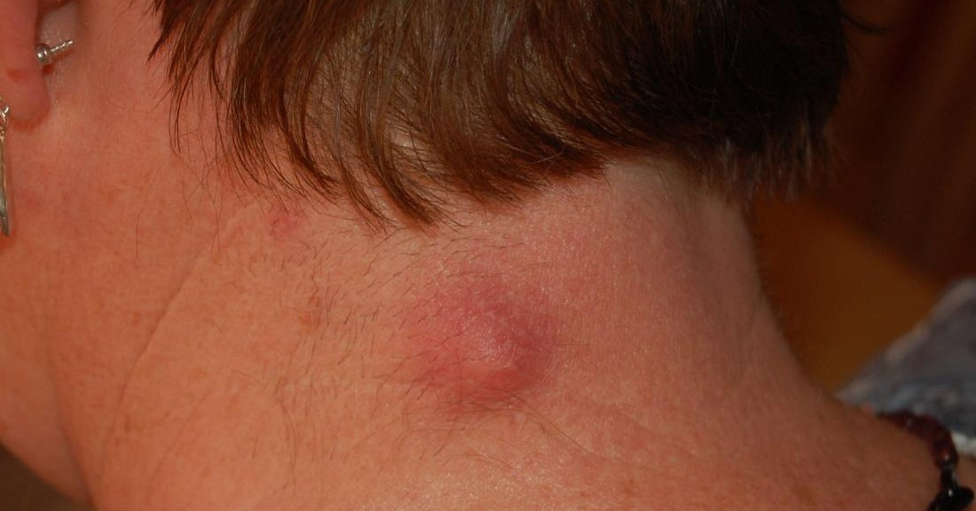 Necrosis of the skin on the nape of the neck just because of a small pimple like a pea