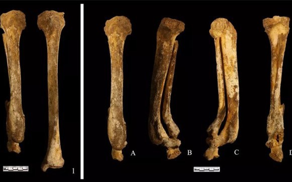 Ancient skeletons reveal the punishment of cutting off the feet of Chinese women 3,000 years ago