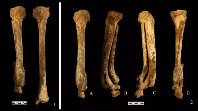 Ancient skeletons revealed the punishment of cutting off the feet of Chinese women 3,000 years ago - Photo 1.