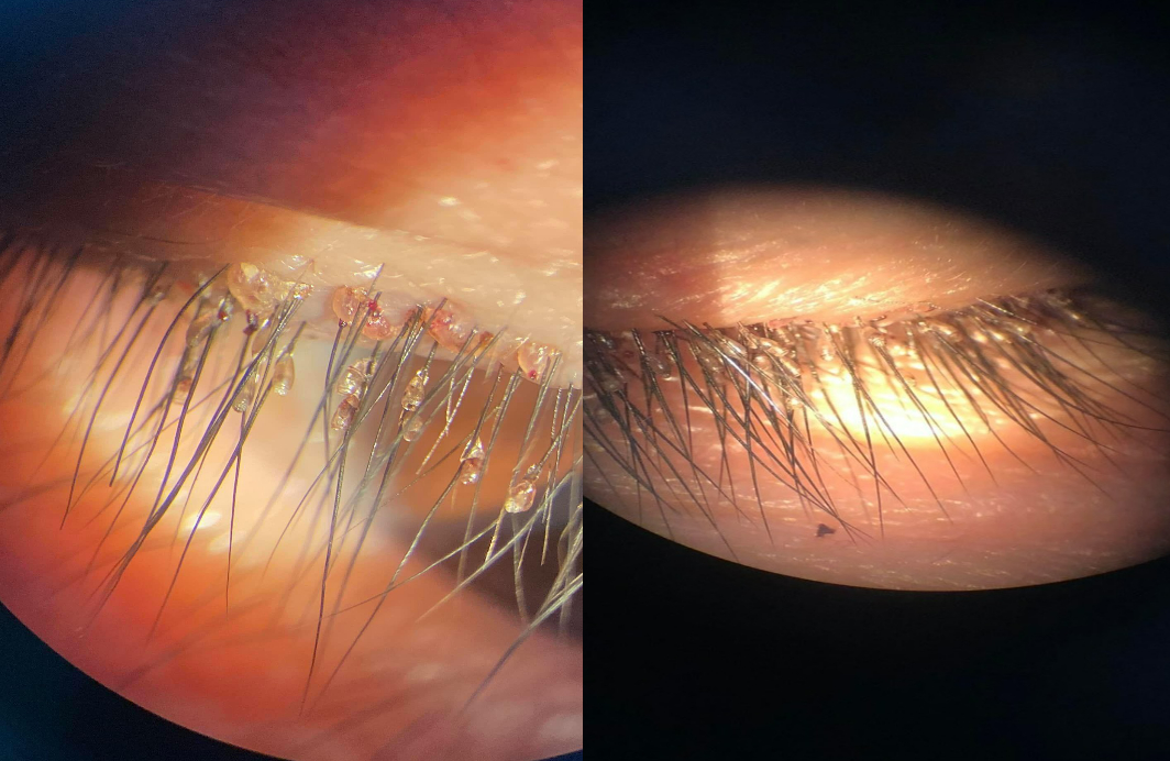 Rare: Nearly 100 pubic lice nest on the patient's male eyelid - Photo 1.