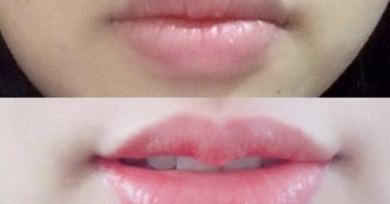 Beauty establishments that do not allow “underground” lip surgery are fined 90 million VND