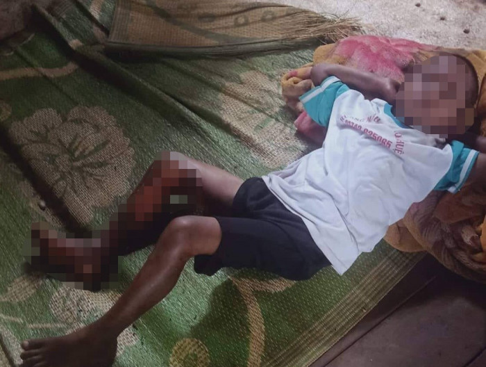 Bé trai 8 tuổi bị đốt bỏng chân ở Đắk Lắk chỉ là do... tai nạn - Ảnh 1.