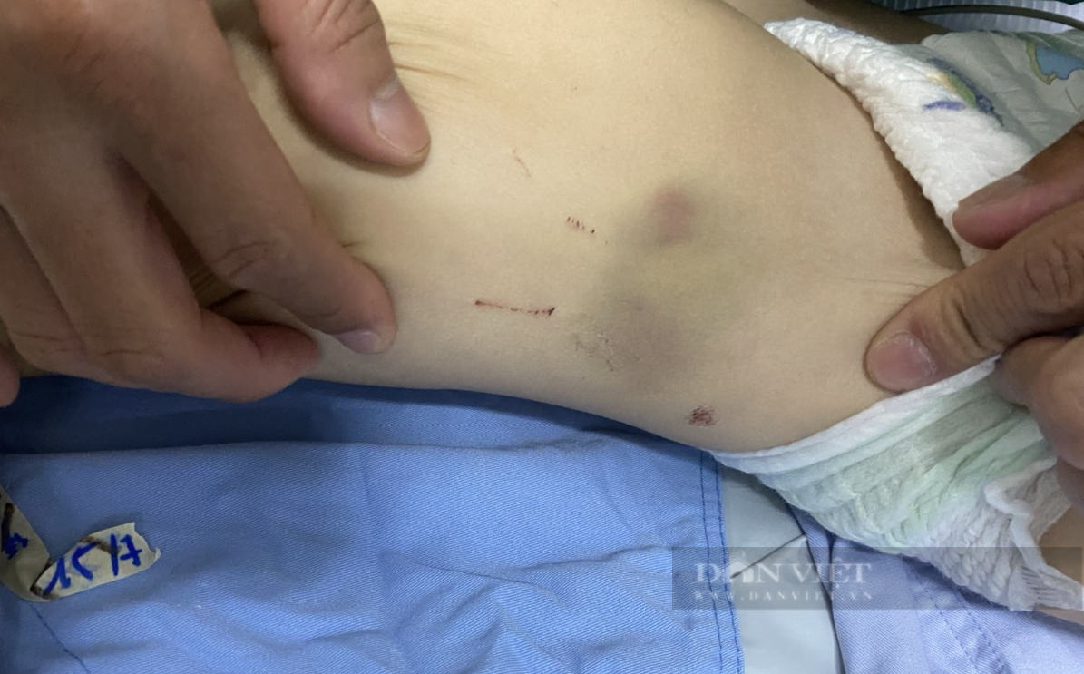 Vụ bạo hành cháu bé 2 tuổi chấn thương sọ não: 2 bảo mẫu thường đánh vào người và chân nạn nhân - Ảnh 4.