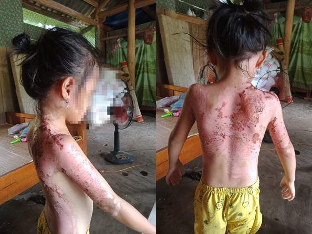 Phú Thọ: Cháu bé 7 tuổi bị hàng xóm tạt nước sôi - Ảnh 1.