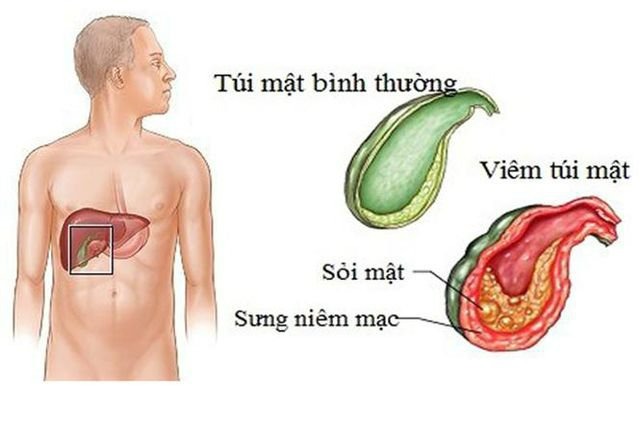 Viêm túi mật do sỏi, bệnh thường gặp không được chủ quan - Ảnh 1.