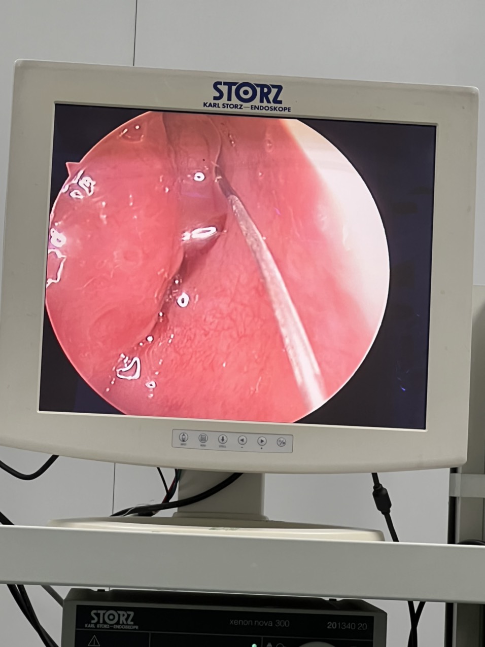 BVĐK tỉnh Sơn La: Đưa vào sử dụng hệ thống máy khoan cắt tốc độ cao trong phẫu thuật nội soi mũi xoang - Ảnh 3.