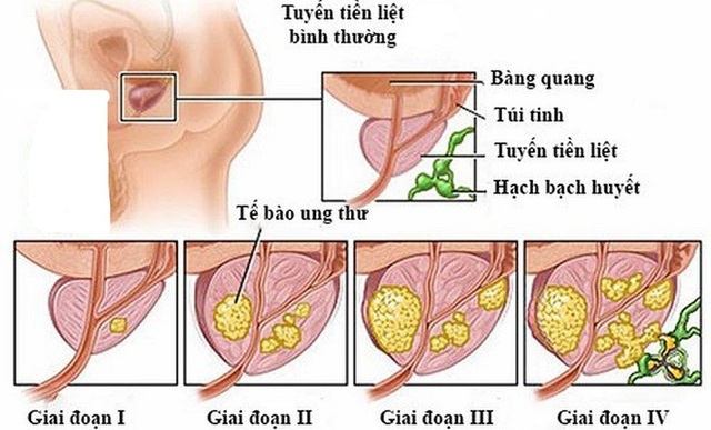 5 bệnh ung thư thường gặp ở nam giới, các anh em cần lưu ý những dấu hiệu dưới đây - Ảnh 5.