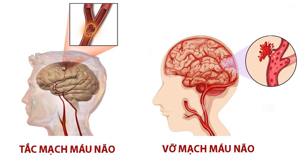 Chuyên gia y tế mách dấu hiệu nhận biết đột quỵ não và cách sơ cứu ban đầu - Ảnh 1.