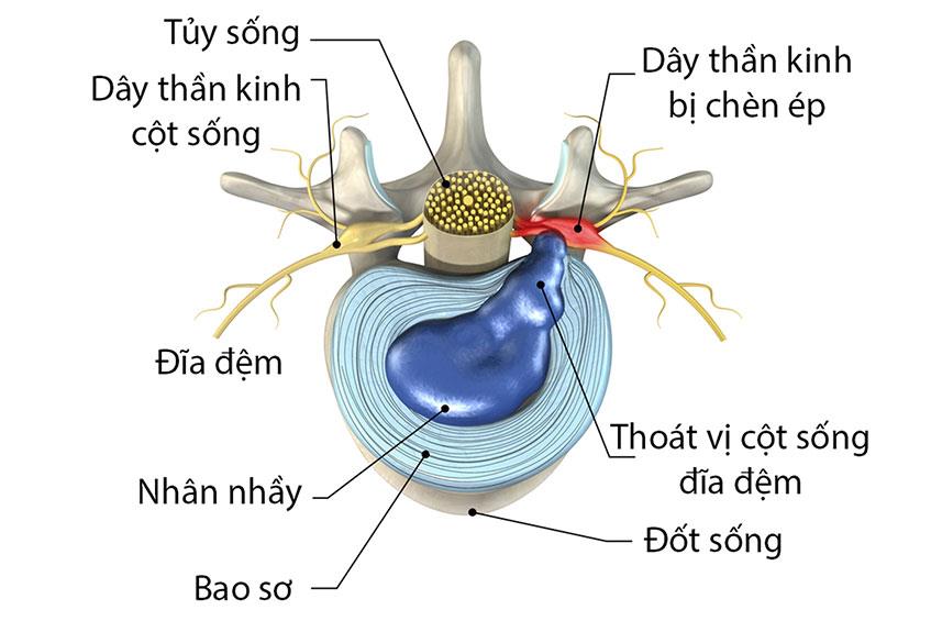 Cốt Thoái Vương - Giải pháp hỗ trợ điều trị thoát vị đĩa đệm hiệu quả - Ảnh 1.