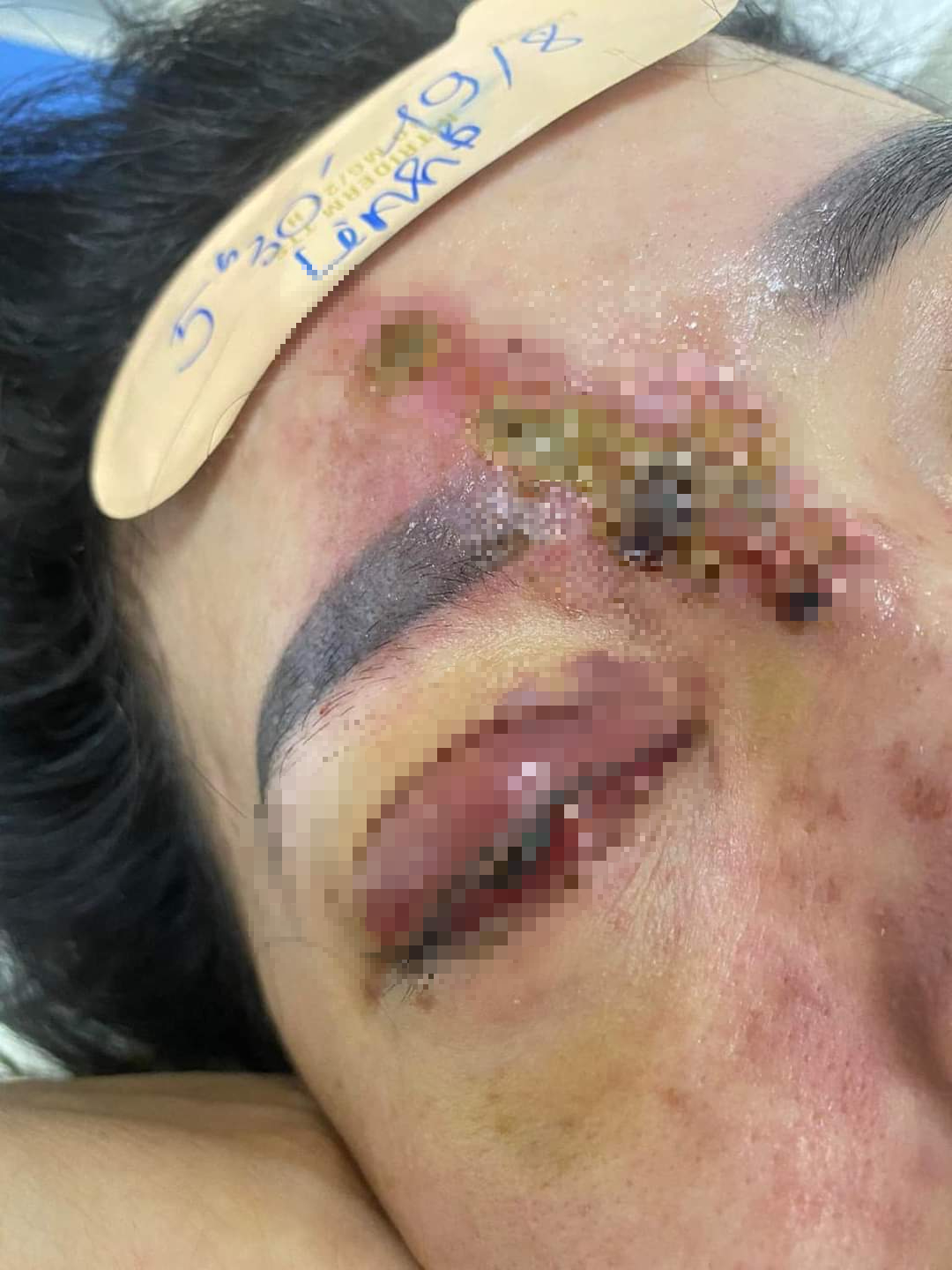 Cô gái bị mù mắt phải sau khi tiêm filler nâng mũi tại Đà Nẵng - Ảnh 2.