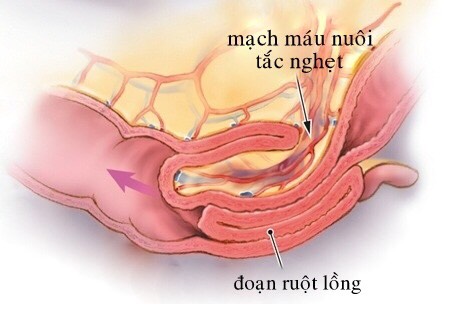 Trẻ đau bụng quấy khóc nhiều giờ, hóa ra bị lồng ruột cấp - Ảnh 2.