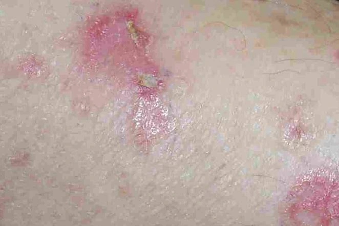 Vết đỏ trên da có thể là dấu hiệu tiền ung thư - Ảnh 1.