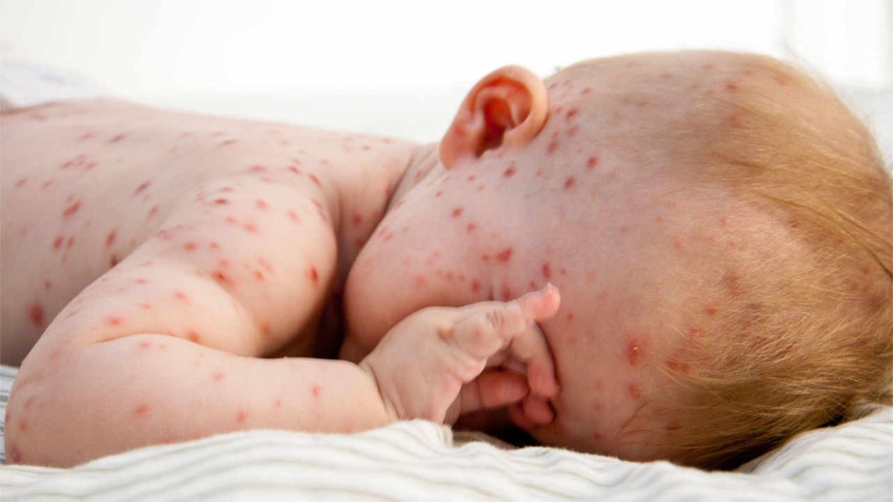 Cẩn trọng với những biến chứng thuỷ đậu nguy hiểm ở trẻ và giải pháp từ gel Subạc - Ảnh 2.