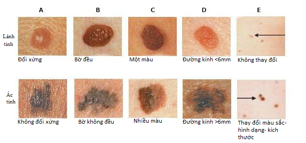 Nhận biết nốt ruồi hay ung thư hắc tố như thế nào? - Ảnh 1.