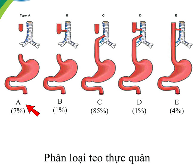 Tạo hình thực quản bằng đại tràng cho bé gái 15 tháng tuổi - Ảnh 1.