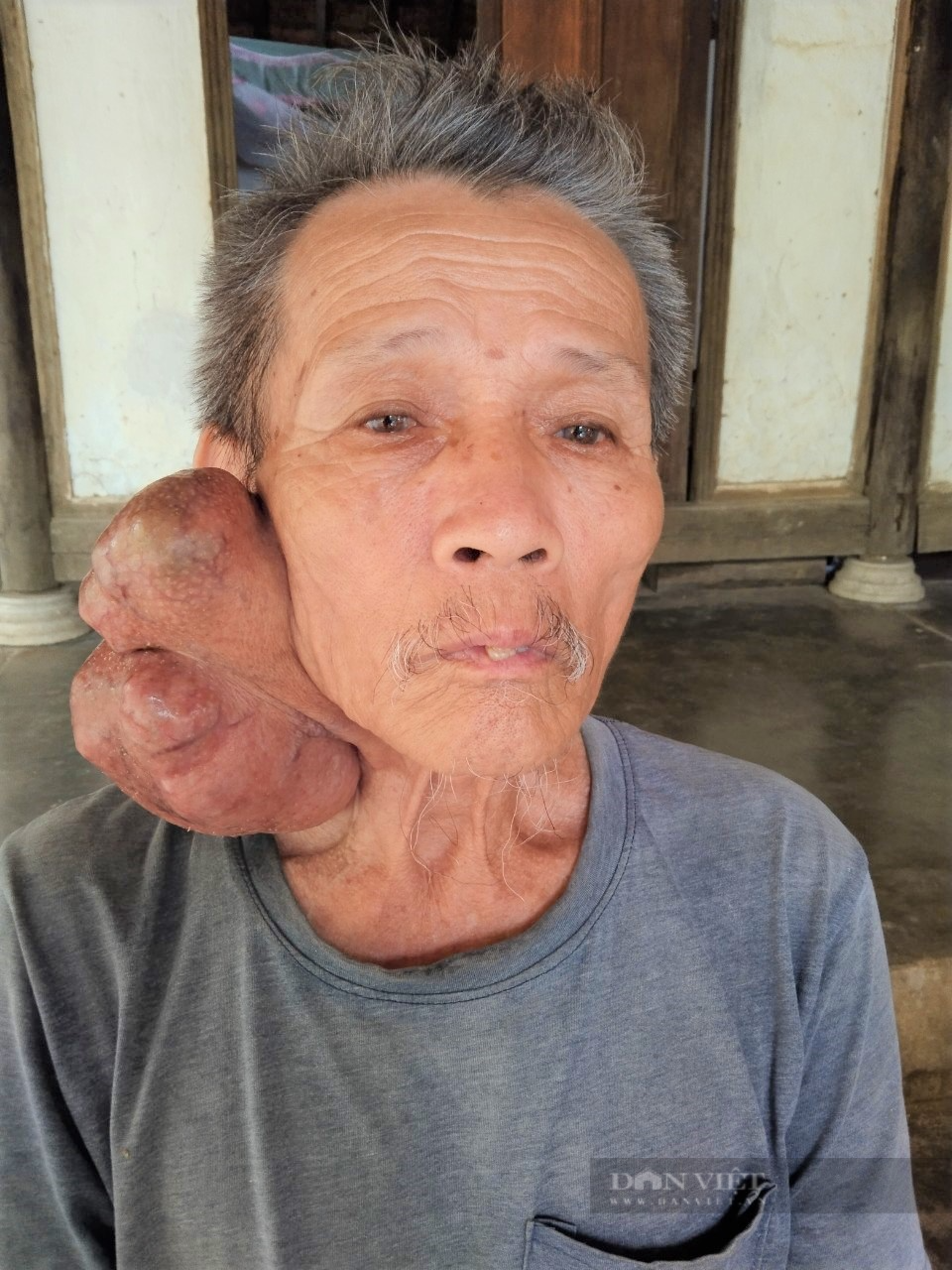 Báo NTNN/Điện tử Dân Việt trao hỗ trợ 5 triệu đồng giúp gia đình cụ ông mang khối u lạ nặng 1kg ở cổ - Ảnh 1.