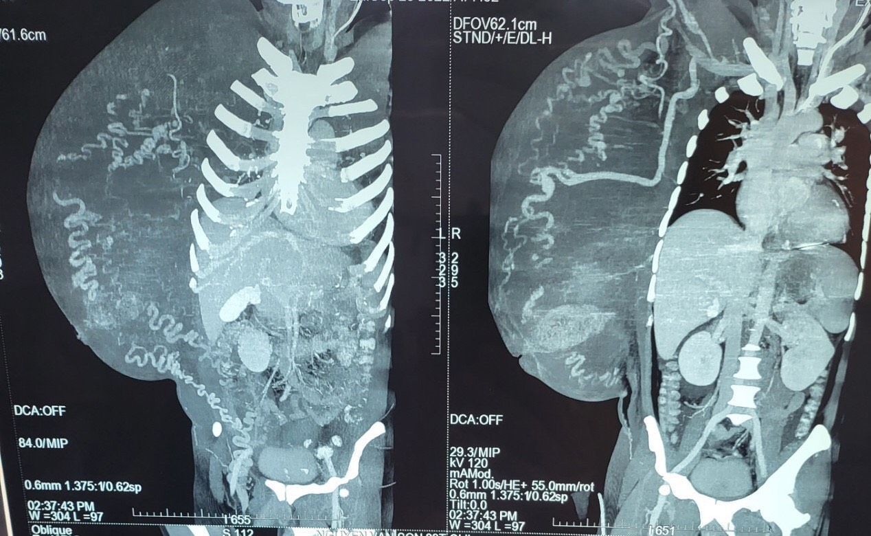 Sửng sốt với khối u to hơn cả người, đe dọa tính mạng bệnh nhân - Ảnh 2.