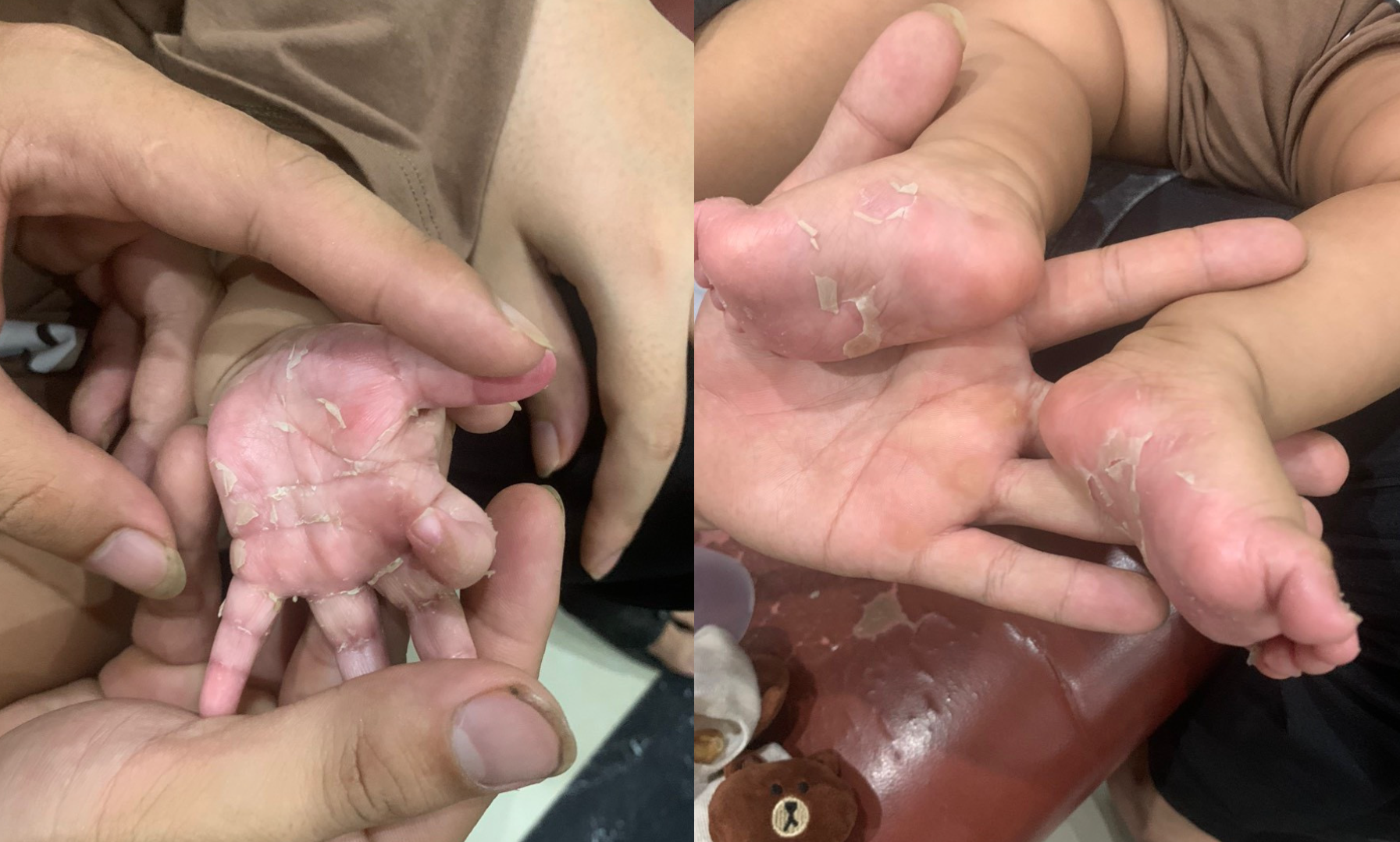 Trẻ 3 tháng tuổi mắc bệnh giang mai, tay chân bong chóc da - Ảnh 1.