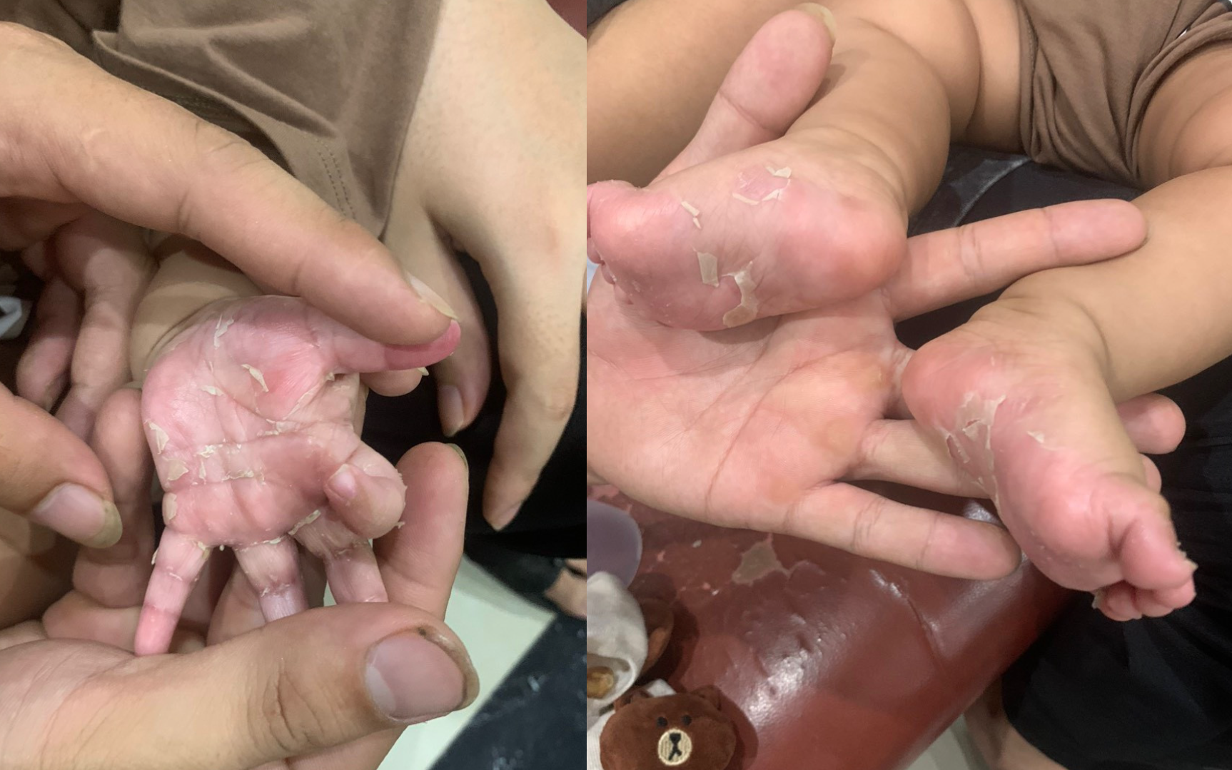 Trẻ 3 tháng tuổi mắc bệnh giang mai, tay chân bong tróc da