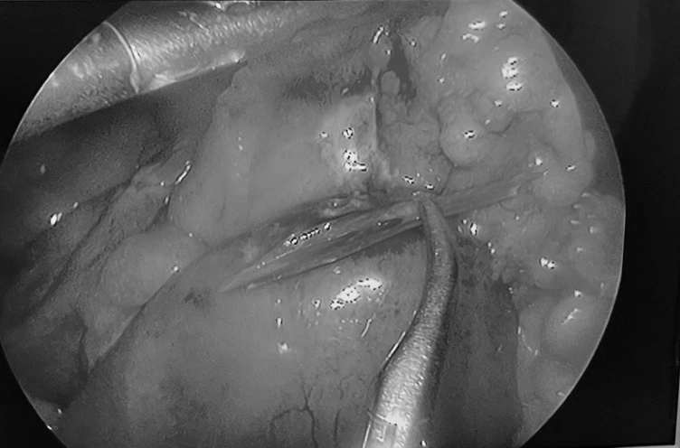Hóc xương cá, nam trung niên nguy kịch vì bị thủng thực quản, tràn mủ màng tim - Ảnh 3.