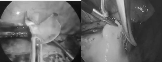 Hóc xương cá, nam trung niên nguy kịch vì bị thủng thực quản, tràn mủ màng tim - Ảnh 2.