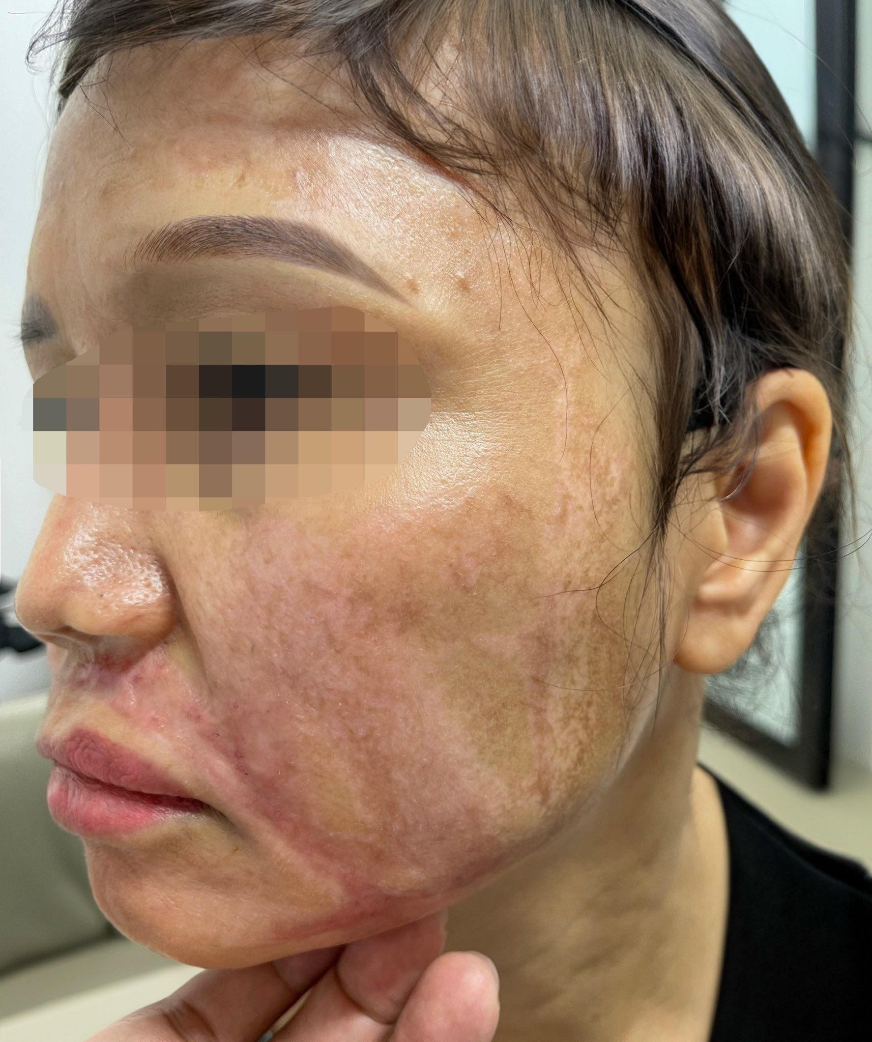 Lột da mặt bằng hoá chất để trị nám ở spa, người phụ nữ bị bỏng nặng gây biến chứng sẹo xấu trên mặt - Ảnh 1.