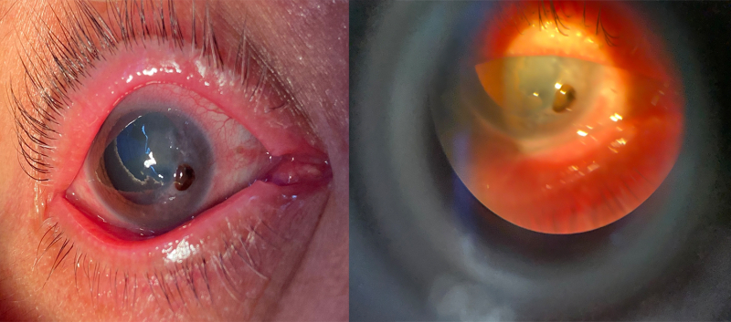 Đau mắt đỏ không điều trị dứt điểm khiến giác mạc bị thủng, nguy cơ mù lòa - Ảnh 1.