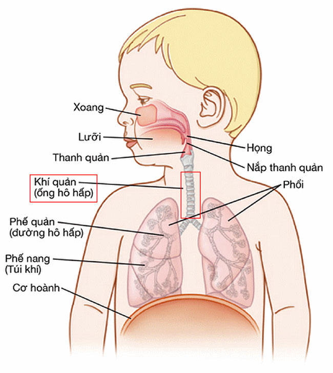 Con khò khè điều trị viêm phổi mãi không khỏi hóa ra bệnh hẹp khí quản nguy hiểm - Ảnh 1.