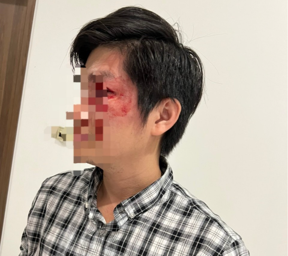 TP.HCM: Một người đàn ông bị đánh rách mí mắt trái khâu 5 mũi, vỡ mảnh răng cửa… vì chó thả rông ở chung cư - Ảnh 1.