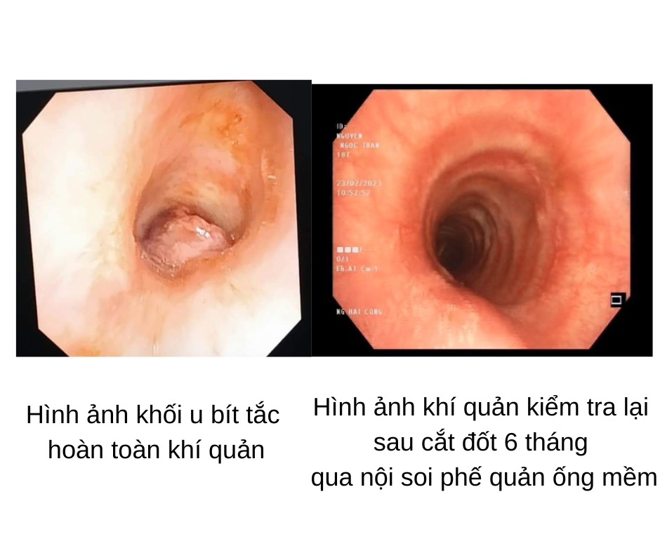 Tưởng hen phế quản, thiếu nữ suýt nguy kịch vì khối u hiếm gặp - Ảnh 1.