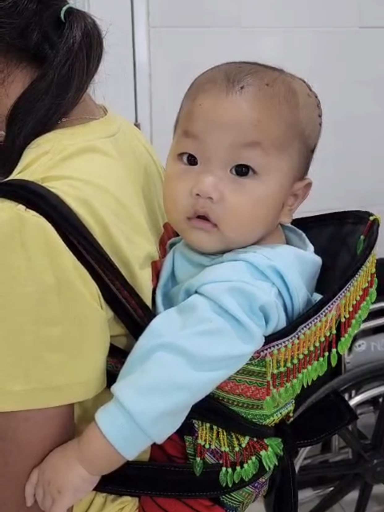 Phẫu thuật cấp cứu thành công bé trai 10 tháng tuổi bị ngã bể lún sọ - Ảnh 3.