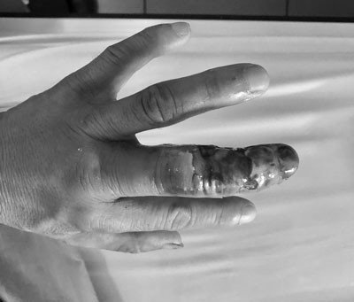 Tự đắp thuốc nam chữa rắn cắn, nam bệnh nhân phải tháo ngón tay - Ảnh 2.