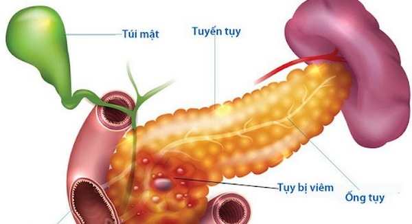 Nam thanh niên, viêm tụy mạn, ung thư tụy sau 22 năm nghiện rượu, hút thuốc lá - Ảnh 4.