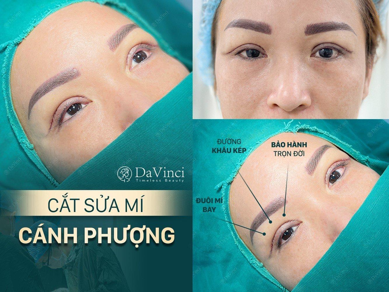 Cắt Sửa mí mắt tại Thẩm mỹ viện DaVinci có tốt an toàn và uy tín không? - Ảnh 1.