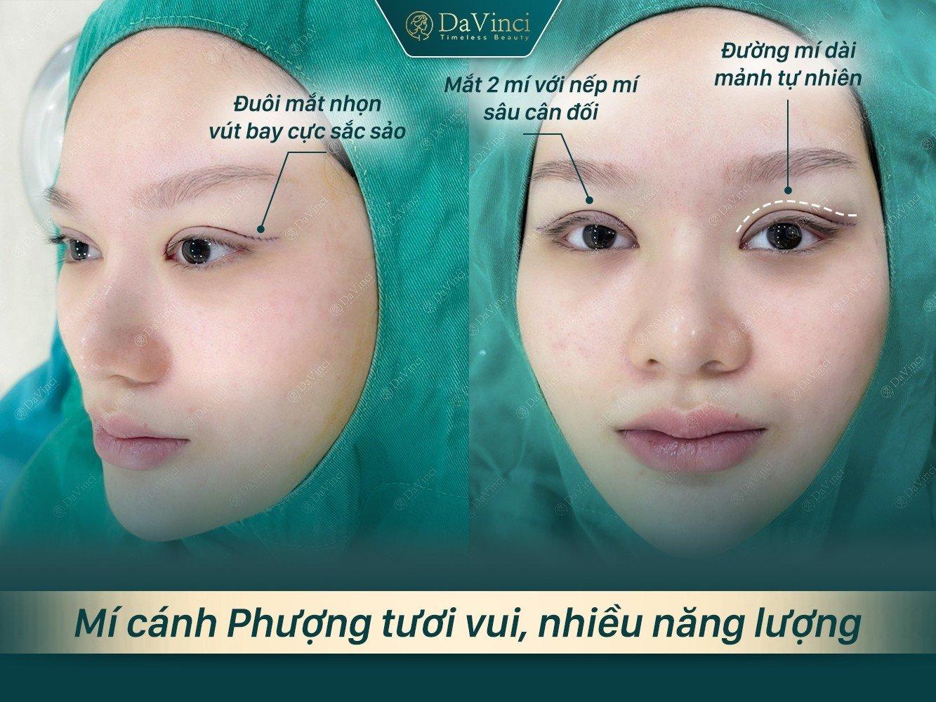 Cắt Sửa mí mắt tại Thẩm mỹ viện DaVinci có tốt an toàn và uy tín không? - Ảnh 2.