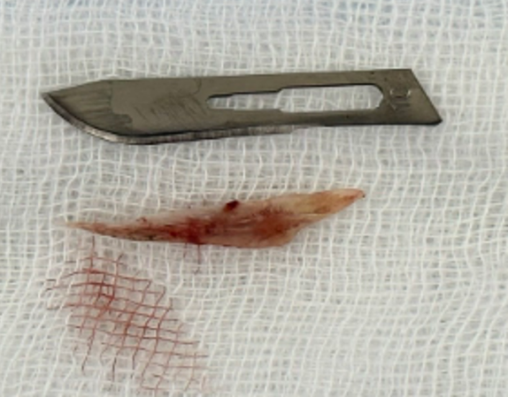 Hy hữu: Xương cá rô phi xuyên thủng thực quản và động mạch chủ ngực - Ảnh 3.