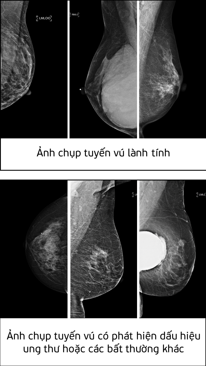 Chuyên gia AI của Viettel xuất sắc giành giải nhất cuộc thi &quot;Phát hiện ung thư vú qua sàng lọc nhũ ảnh&quot; - Ảnh 2.