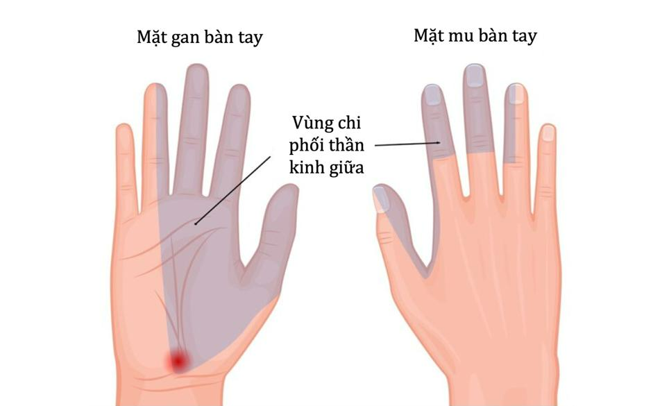 Tay tê rần, đau nhức, coi chừng hội chứng ống cổ tay - Ảnh 1.