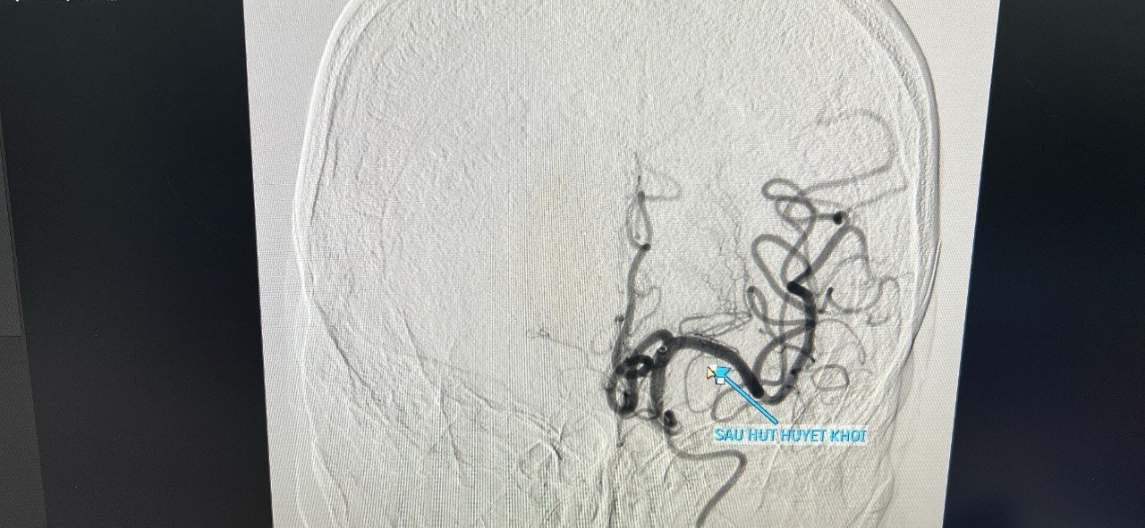 BV Đại học Y dược Buôn Ma Thuột cấp cứu &quot;ngoạn mục&quot; ca đột quỵ nhồi máu não giờ thứ 7 - Ảnh 2.