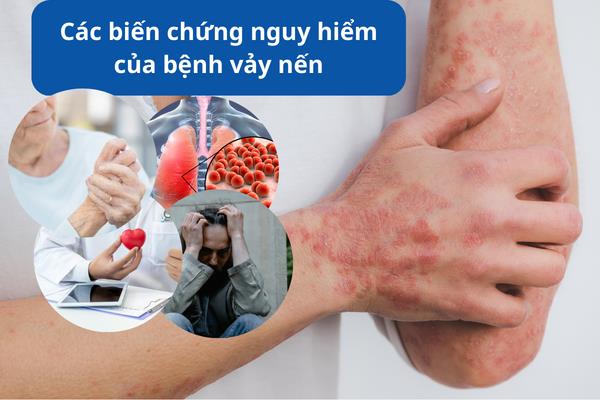 Làm gì để ngăn ngừa biến chứng của vảy nến và giải pháp từ Kim Miễn Khang? - Ảnh 1.