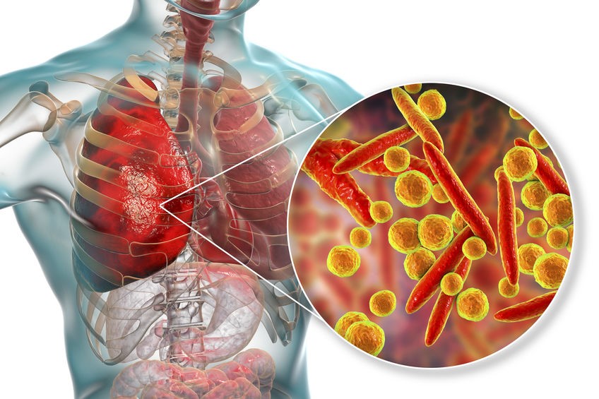 Cảnh giác với bệnh viêm phổi do vi khuẩn, dễ lây, biến chứng nguy hiểm - Ảnh 1.