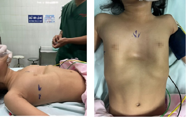 Phẫu thuật &quot;2 trong 1&quot; cứu bé 3 tuổi vừa lõm ngực nặng vừa có kén khí trong phổi - Ảnh 1.