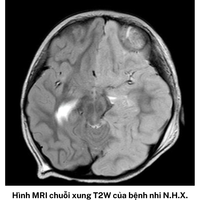 Cứu sống hai trẻ bị phù não do bệnh hiếm gặp - Ảnh 1.