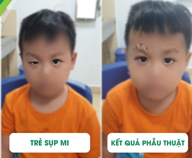 Sụp mi mắt phải làm sao?  - Ảnh 2.