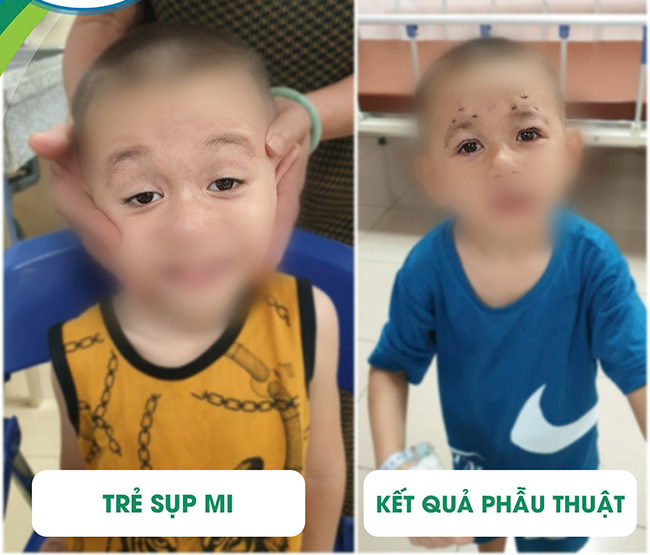 Sụp mi mắt phải làm sao?  - Ảnh 3.